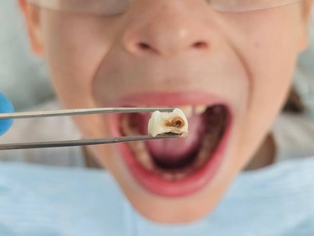 Best Emergency Dental Care for Broken or Chipped Teeth in Chesapeake, WV