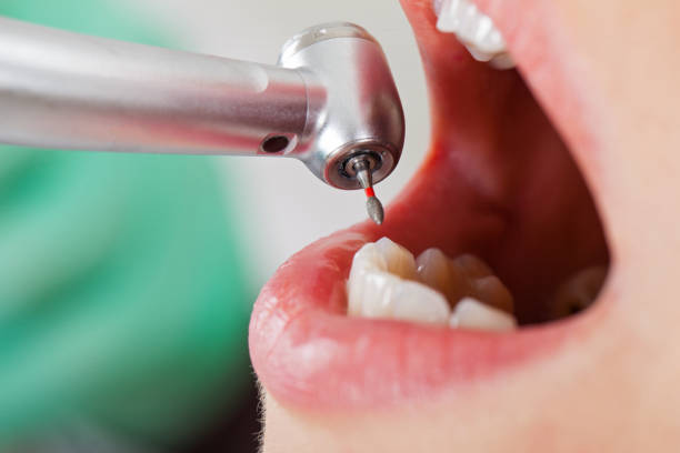 Best Urgent Care for Lost Fillings or Crowns in Chesapeake, WV